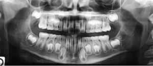 Cet abcès aux dents – Hélène Lebougault
